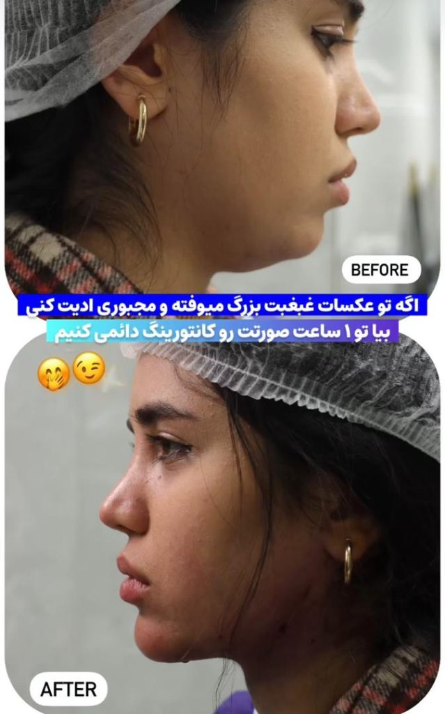 لیپو فیس