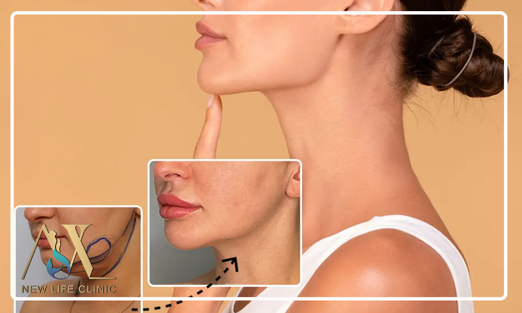 چطور جراح مناسب برای لیپو ساکشن غبغب انتخاب کنیم؟